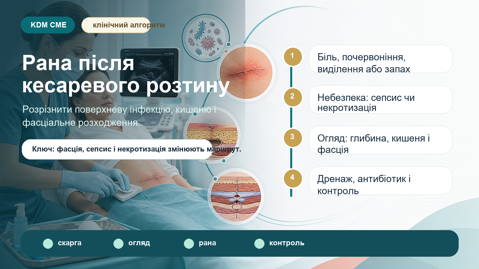 Інфографіка алгоритму інфекції або розходження рани після кесаревого розтину: біль, почервоніння, тепло, виділення або запах після виписки, небезпечні ознаки сепсису, некротизуючої інфекції і нецілої фасції, огляд рани, вимірювання почервоніння, перевірка глибини та кишені, дренаж сероми, гематоми або абсцесу, антибіотик, перев’язки і контроль 24-48 годин.