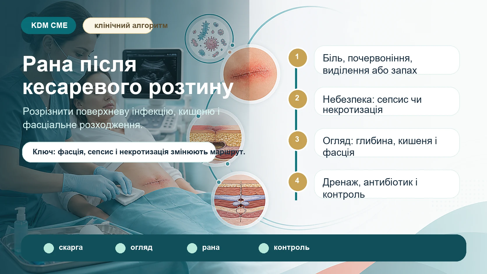 Інфографіка алгоритму інфекції або розходження рани після кесаревого розтину: біль, почервоніння, тепло, виділення або запах після виписки, небезпечні ознаки сепсису, некротизуючої інфекції і нецілої фасції, огляд рани, вимірювання почервоніння, перевірка глибини та кишені, дренаж сероми, гематоми або абсцесу, антибіотик, перев’язки і контроль 24-48 годин.