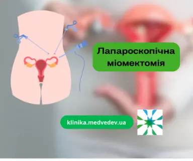 Лапароскопічна міомектомія